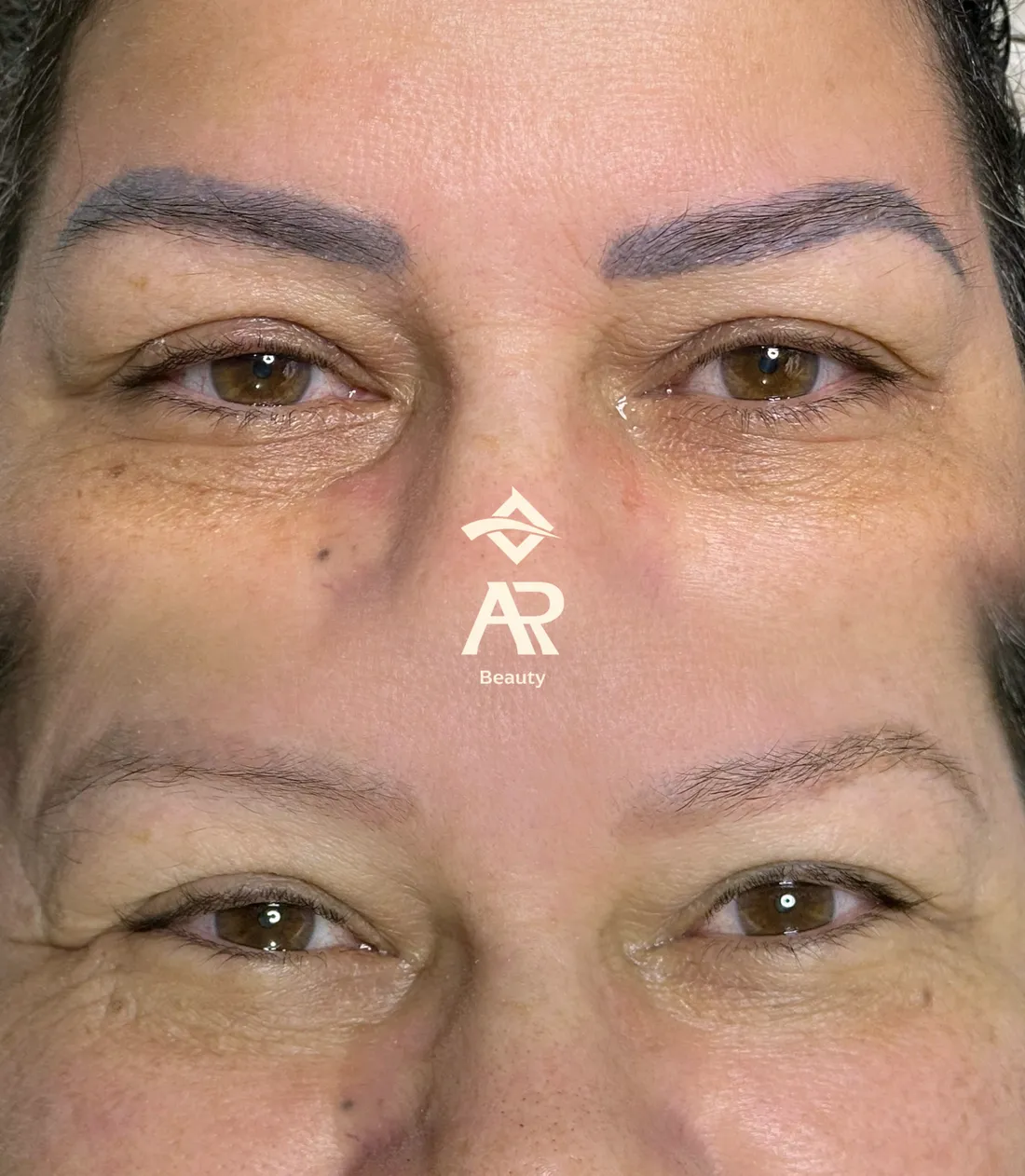 Resultado real de remoção a laser