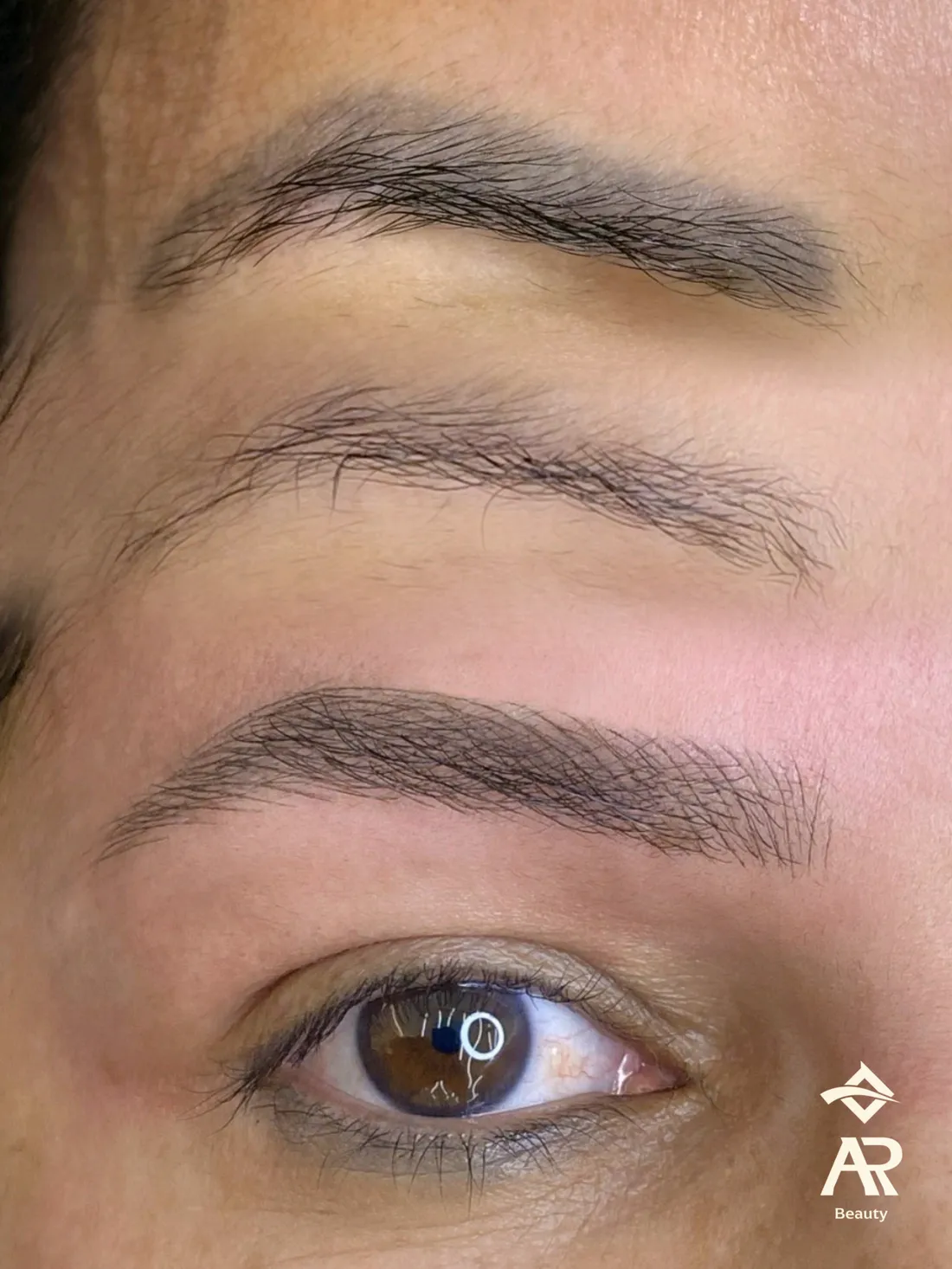 Resultado real de remoção a laser