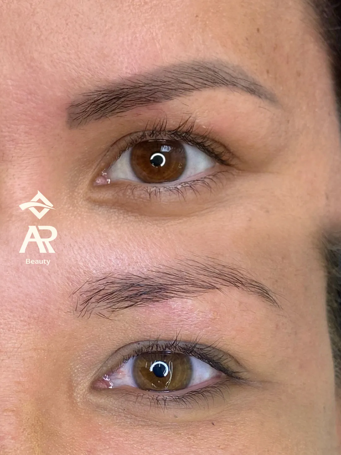 Resultado real de remoção a laser